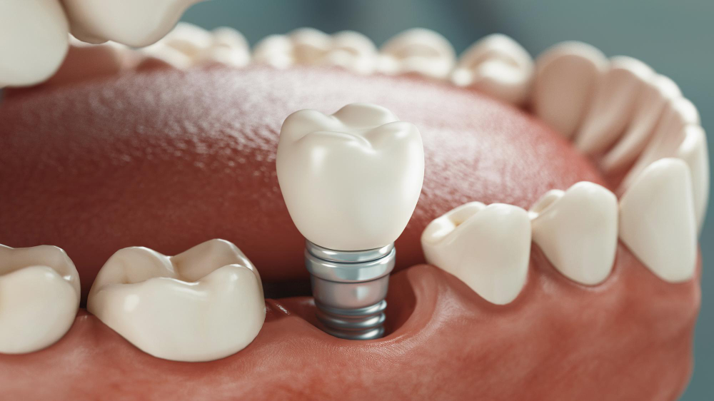 Dental Implants  Harbor City, CA