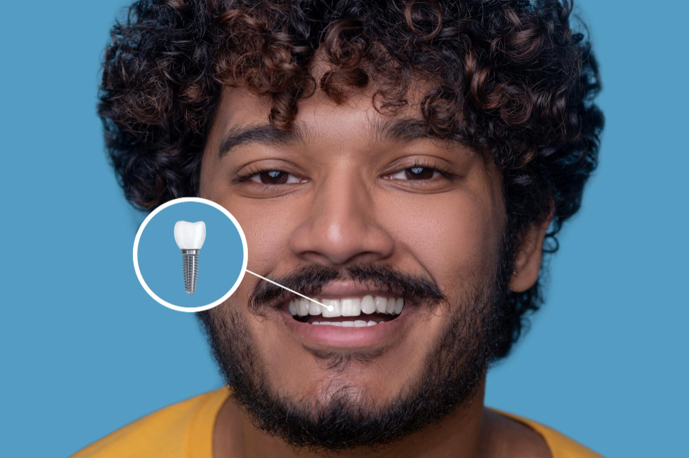 Implant Restoration  Harbor City, CA